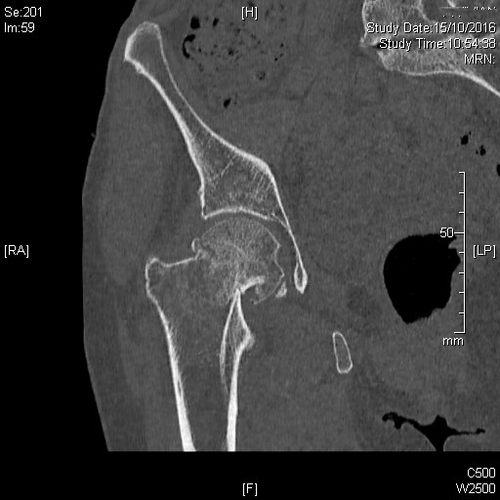 Cliché TDM d'une fracture du col Fémoral